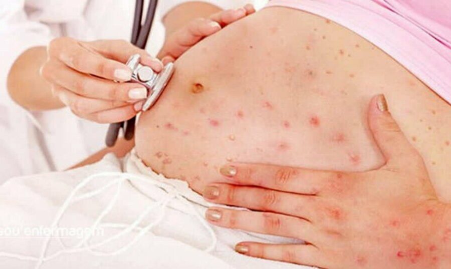 HEMNSL alerta sobre o risco da sífilis na gestação