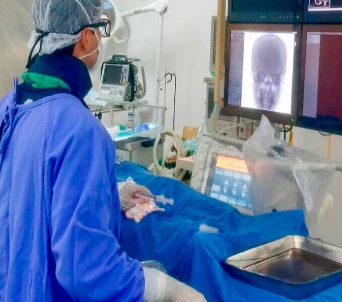 Hugol realiza procedimento inédito na unidade para tratamento de AVC