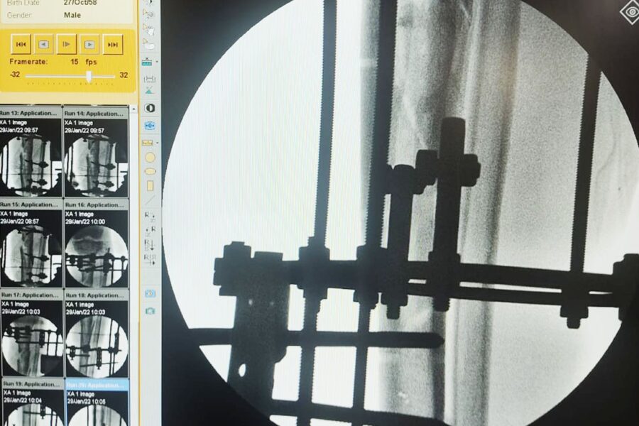 Hospital de Formosa faz primeira cirurgia ortopédica usando técnica Ilizarov