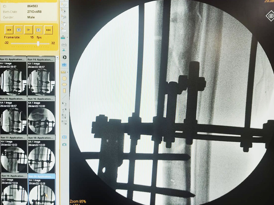 Hospital de Formosa faz primeira cirurgia ortopédica usando técnica Ilizarov