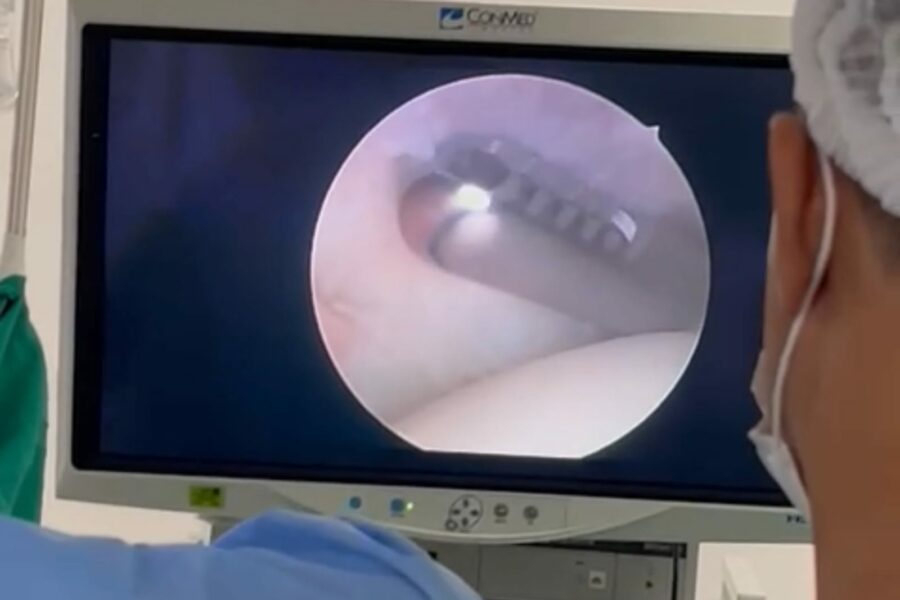 HCN realiza 1ª cirurgia com alta tecnologia por vídeo no Centro-Norte do Estado