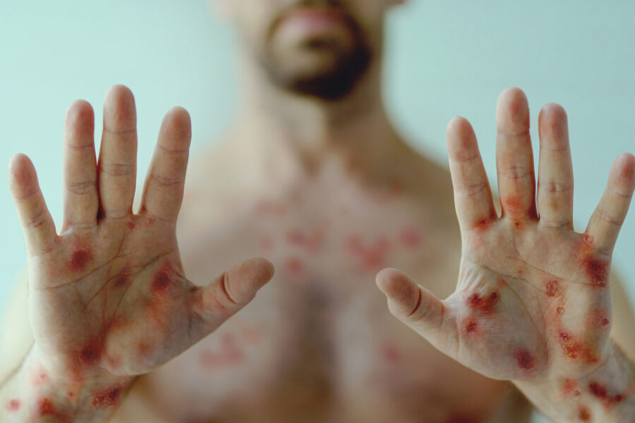 SES publica Plano de Contingência da monkeypox e diz que nível 3 é classificação técnica