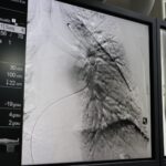 HGG é o único hospital público a realizar angioplastia pulmonar por balão em Goiás