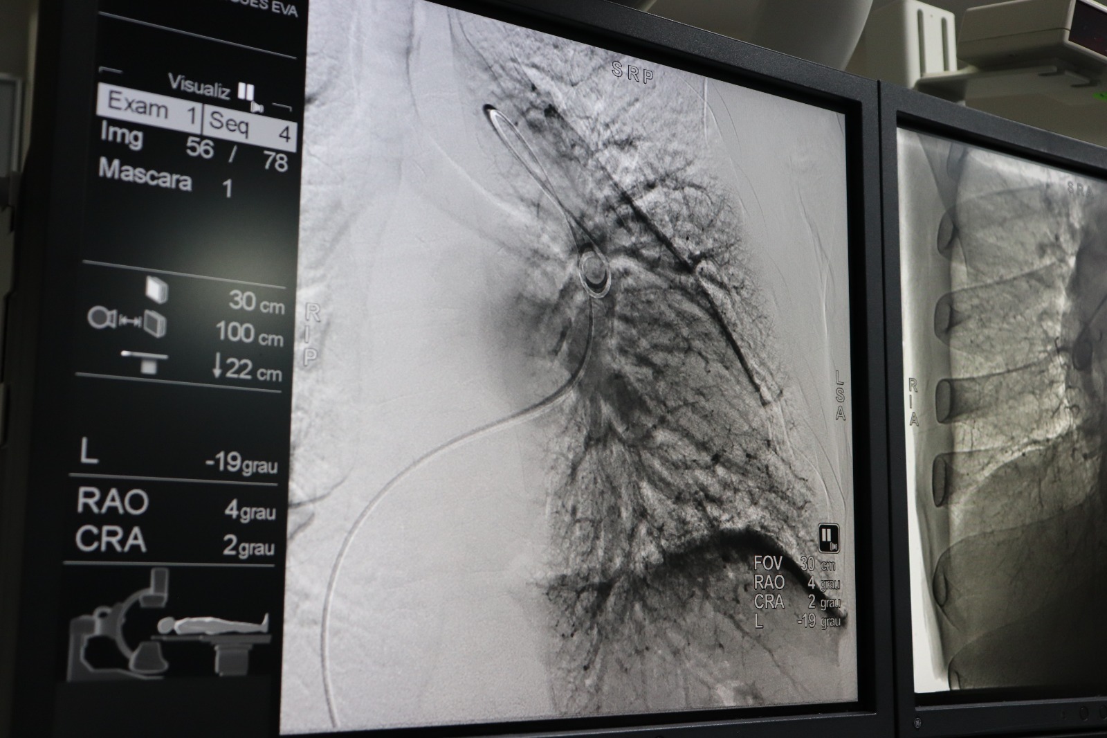 HGG é o único hospital público a realizar angioplastia pulmonar por balão em Goiás